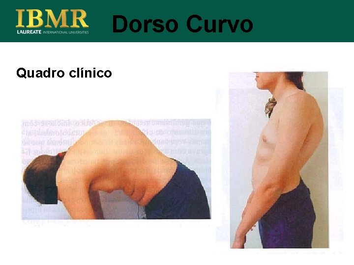 Dorso Curvo Quadro clínico 