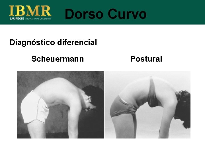 Dorso Curvo Diagnóstico diferencial Scheuermann Postural 