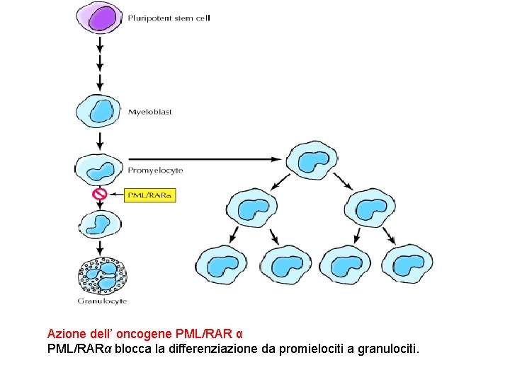 Azione dell’ oncogene PML/RAR α PML/RARα blocca la differenziazione da promielociti a granulociti. 