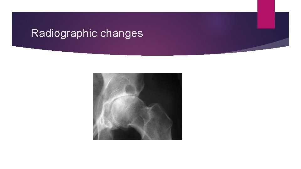 Radiographic changes 