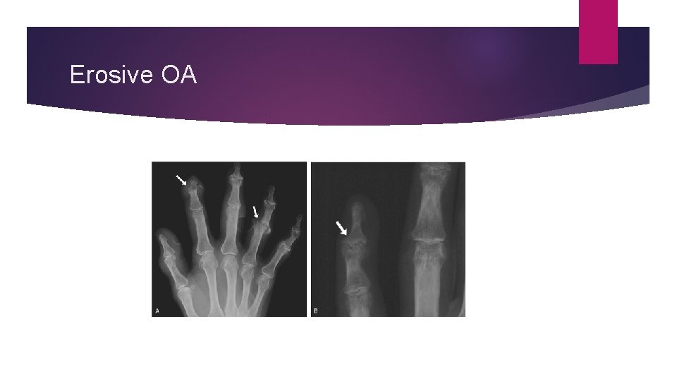 Erosive OA 