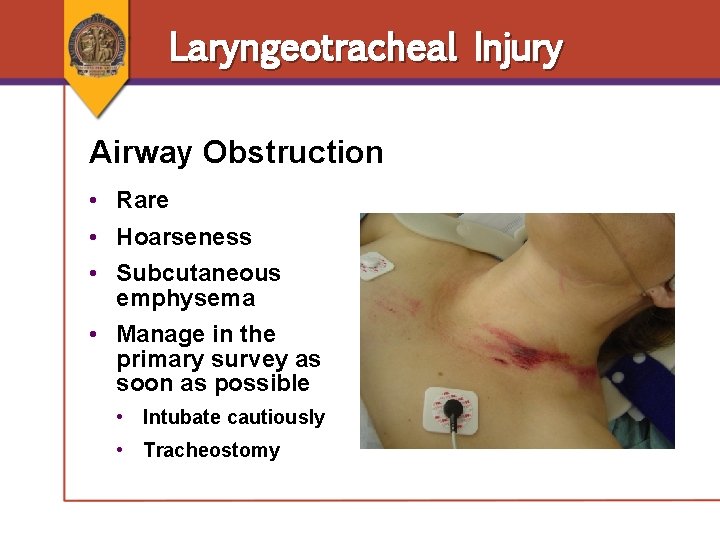 Laryngeotracheal Injury Airway Obstruction • Rare • Hoarseness • Subcutaneous emphysema • Manage in Laryngeotracheal Injury Airway Obstruction • Rare • Hoarseness • Subcutaneous emphysema • Manage in