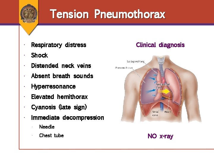 Tension Pneumothorax • Respiratory distress Clinical diagnosis • Shock • Distended neck veins • Tension Pneumothorax • Respiratory distress Clinical diagnosis • Shock • Distended neck veins •