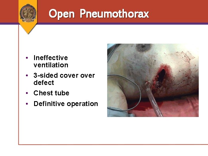 Open Pneumothorax • Ineffective ventilation • 3 -sided cover defect • Chest tube • Open Pneumothorax • Ineffective ventilation • 3 -sided cover defect • Chest tube •