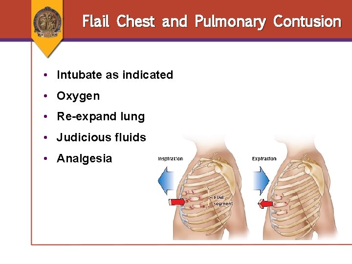 Flail Chest and Pulmonary Contusion • Intubate as indicated • Oxygen • Re-expand lung Flail Chest and Pulmonary Contusion • Intubate as indicated • Oxygen • Re-expand lung
