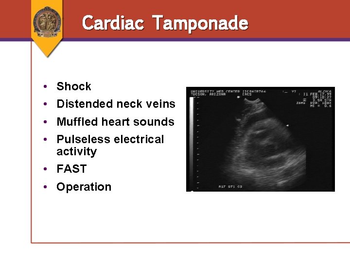 Cardiac Tamponade • • Shock Distended neck veins Muffled heart sounds Pulseless electrical activity Cardiac Tamponade • • Shock Distended neck veins Muffled heart sounds Pulseless electrical activity