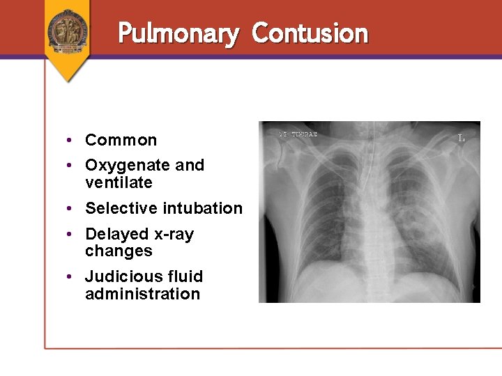 Pulmonary Contusion • Common • Oxygenate and ventilate • Selective intubation • Delayed x-ray Pulmonary Contusion • Common • Oxygenate and ventilate • Selective intubation • Delayed x-ray