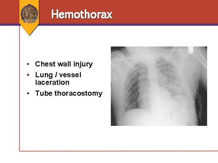 Hemothorax • Chest wall injury • Lung / vessel laceration • Tube thoracostomy Hemothorax • Chest wall injury • Lung / vessel laceration • Tube thoracostomy