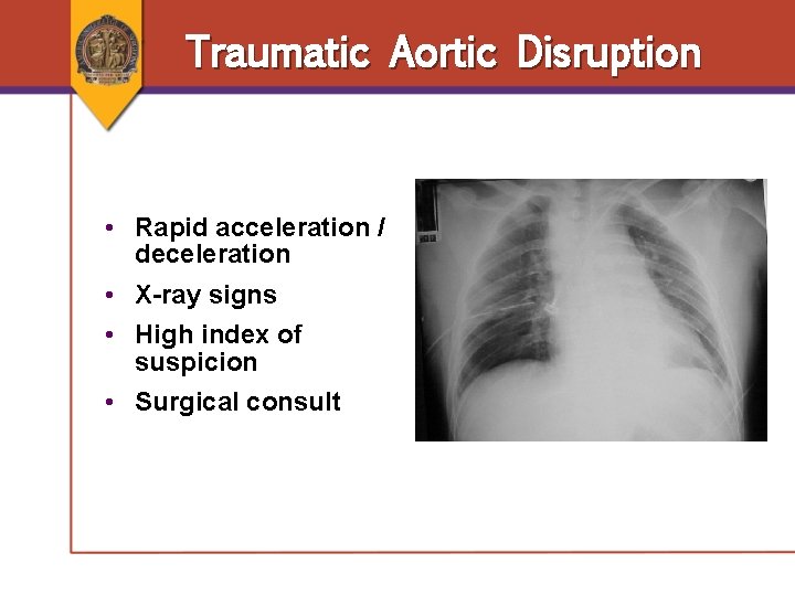 Traumatic Aortic Disruption • Rapid acceleration / deceleration • X-ray signs • High index Traumatic Aortic Disruption • Rapid acceleration / deceleration • X-ray signs • High index