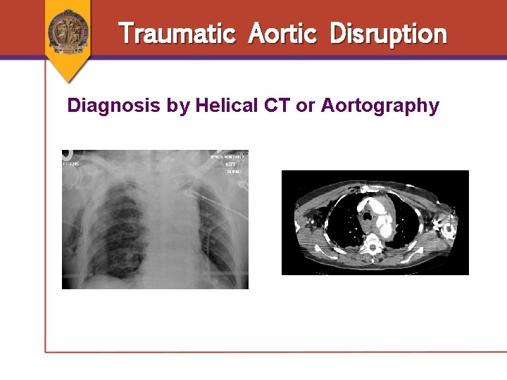 Traumatic Aortic Disruption Diagnosis by Helical CT or Aortography Traumatic Aortic Disruption Diagnosis by Helical CT or Aortography