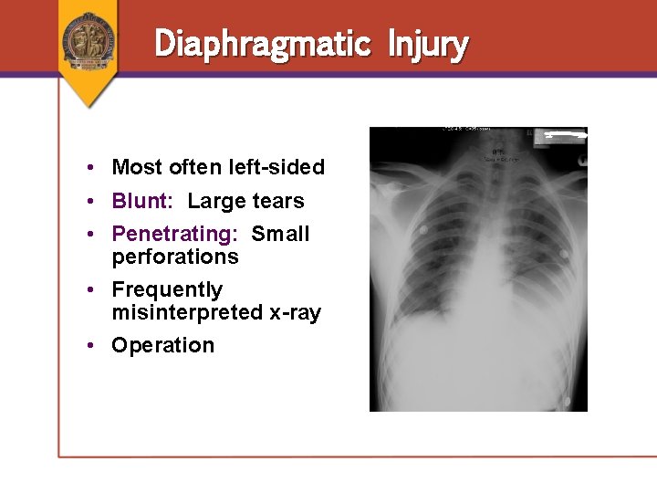 Diaphragmatic Injury • Most often left-sided • Blunt: Large tears • Penetrating: Small perforations Diaphragmatic Injury • Most often left-sided • Blunt: Large tears • Penetrating: Small perforations