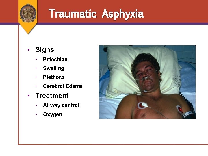 Traumatic Asphyxia • Signs • Petechiae • Swelling • Plethora • Cerebral Edema • Traumatic Asphyxia • Signs • Petechiae • Swelling • Plethora • Cerebral Edema •