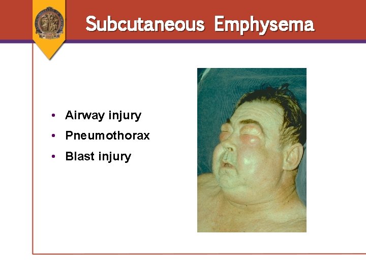 Subcutaneous Emphysema • Airway injury • Pneumothorax • Blast injury Subcutaneous Emphysema • Airway injury • Pneumothorax • Blast injury