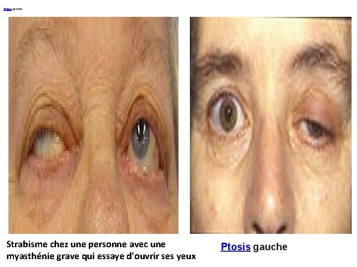 Ptosis gauche Strabisme chez une personne avec une myasthénie grave qui essaye d'ouvrir ses