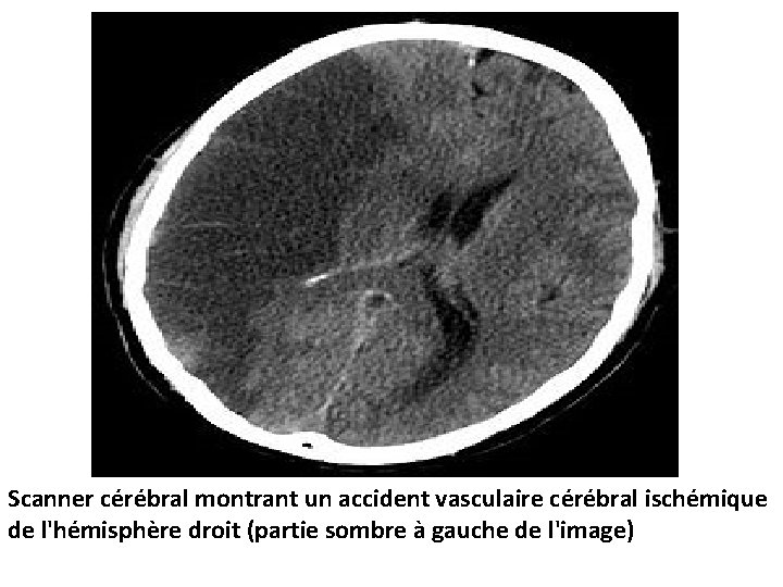 Scanner cérébral montrant un accident vasculaire cérébral ischémique de l'hémisphère droit (partie sombre à