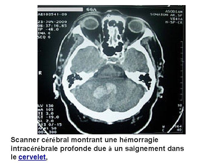 Scanner cérébral montrant une hémorragie intracérébrale profonde due à un saignement dans le cervelet,