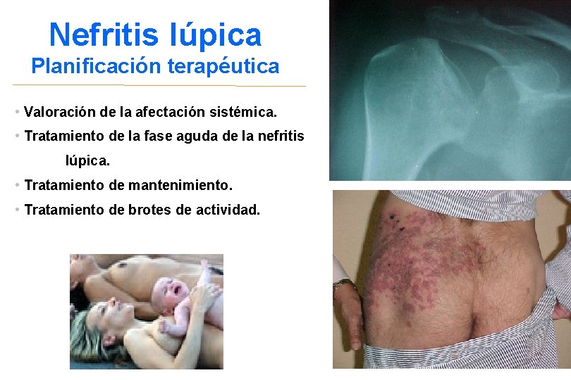 Nefritis lúpica Planificación terapéutica • Valoración de la afectación sistémica. • Tratamiento de la