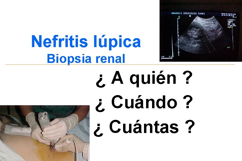 Nefritis lúpica Biopsia renal ¿ A quién ? ¿ Cuándo ? ¿ Cuántas ?