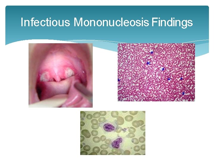 Infectious Mononucleosis Findings Infectious Mononucleosis Findings