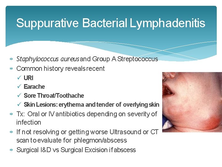 Suppurative Bacterial Lymphadenitis Staphylococcus aureus and Group A Streptococcus Common history reveals recent URI Suppurative Bacterial Lymphadenitis Staphylococcus aureus and Group A Streptococcus Common history reveals recent URI