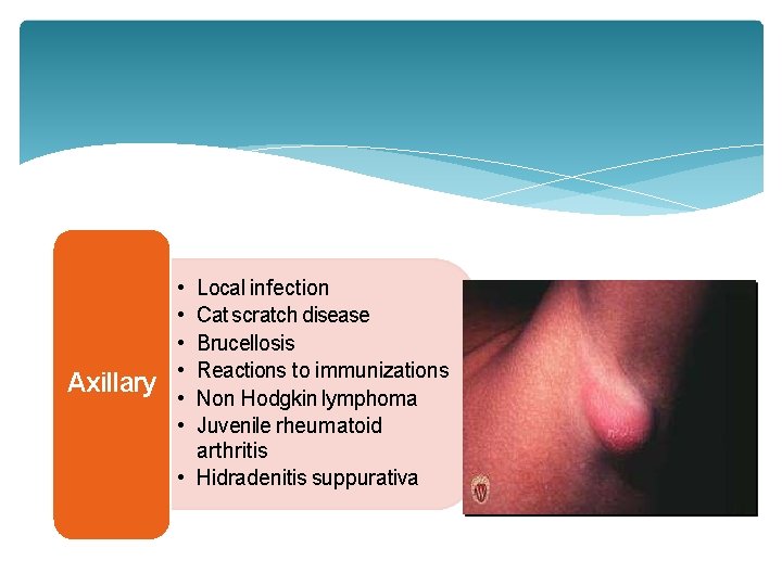 Axillary • • • Local infection Cat scratch disease Brucellosis Reactions to immunizations Non Axillary • • • Local infection Cat scratch disease Brucellosis Reactions to immunizations Non