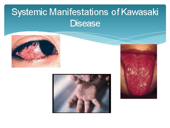 Systemic Manifestations of Kawasaki Disease Systemic Manifestations of Kawasaki Disease