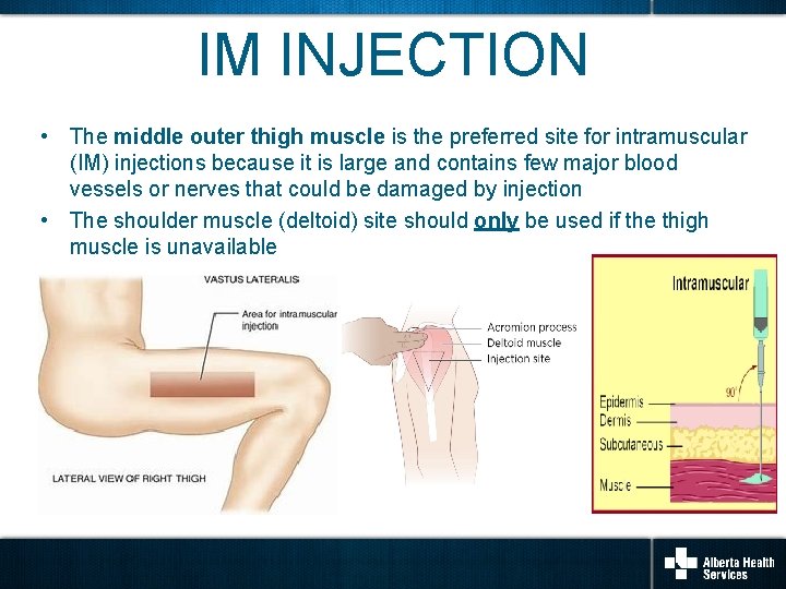 IM INJECTION • The middle outer thigh muscle is the preferred site for intramuscular