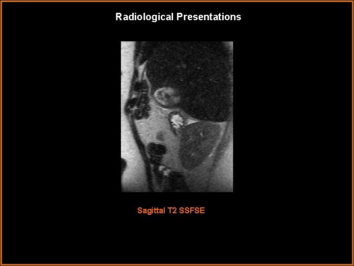Radiological Presentations Sagittal T 2 SSFSE Radiological Presentations Sagittal T 2 SSFSE