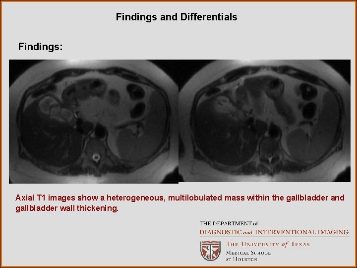Findings and Differentials Findings: Axial T 1 images show a heterogeneous, multilobulated mass within Findings and Differentials Findings: Axial T 1 images show a heterogeneous, multilobulated mass within