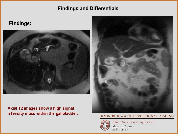 Findings and Differentials Findings: Axial T 2 images show a high signal intensity mass Findings and Differentials Findings: Axial T 2 images show a high signal intensity mass