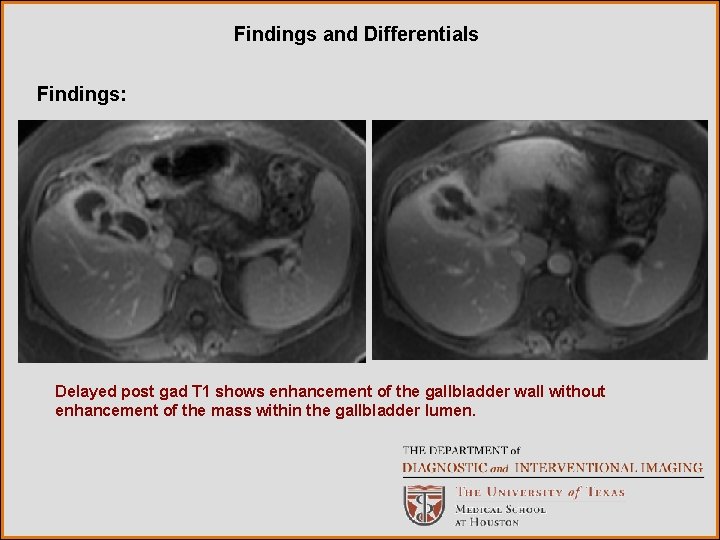 Findings and Differentials Findings: Delayed post gad T 1 shows enhancement of the gallbladder Findings and Differentials Findings: Delayed post gad T 1 shows enhancement of the gallbladder