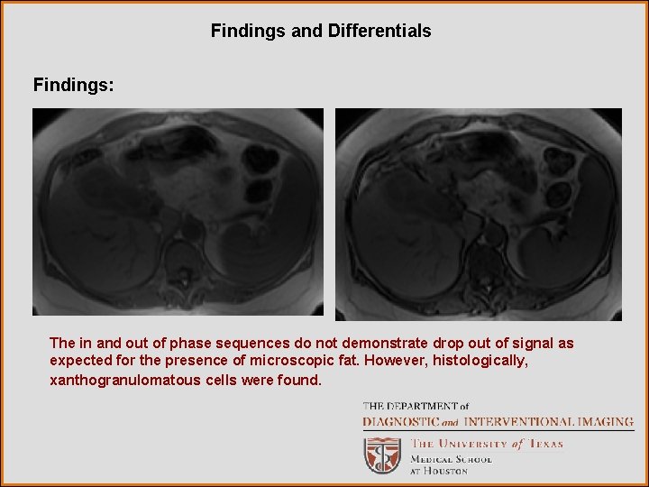 Findings and Differentials Findings: The in and out of phase sequences do not demonstrate Findings and Differentials Findings: The in and out of phase sequences do not demonstrate