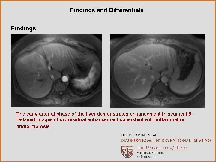 Findings and Differentials Findings: The early arterial phase of the liver demonstrates enhancement in Findings and Differentials Findings: The early arterial phase of the liver demonstrates enhancement in