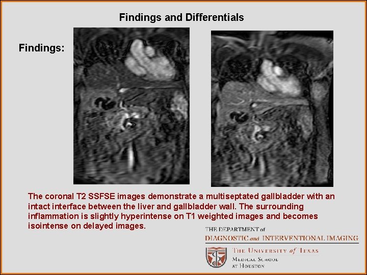 Findings and Differentials Findings: The coronal T 2 SSFSE images demonstrate a multiseptated gallbladder Findings and Differentials Findings: The coronal T 2 SSFSE images demonstrate a multiseptated gallbladder