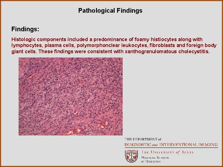 Pathological Findings: Histologic components included a predominance of foamy histiocytes along with lymphocytes, plasma Pathological Findings: Histologic components included a predominance of foamy histiocytes along with lymphocytes, plasma