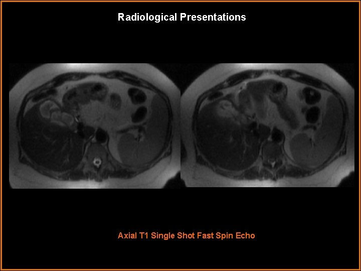 Radiological Presentations Axial T 1 Single Shot Fast Spin Echo Radiological Presentations Axial T 1 Single Shot Fast Spin Echo