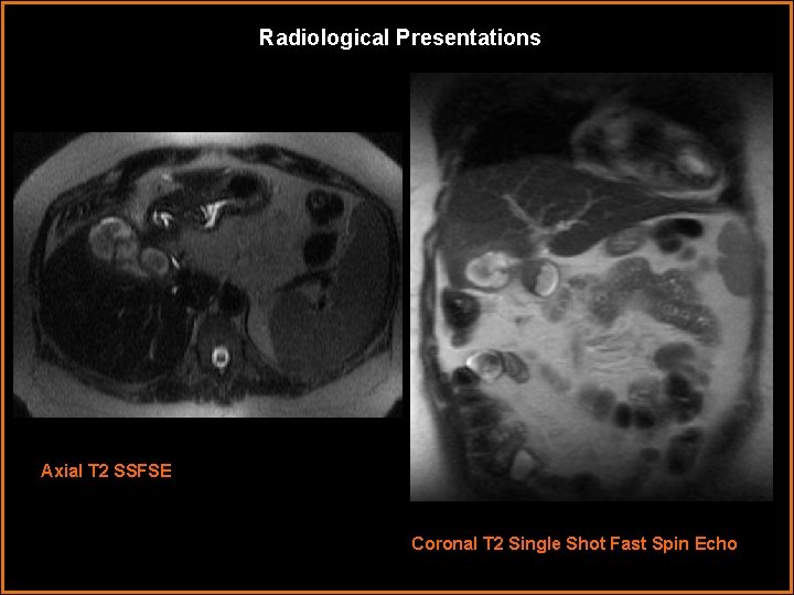 Radiological Presentations Axial T 2 SSFSE Coronal T 2 Single Shot Fast Spin Echo Radiological Presentations Axial T 2 SSFSE Coronal T 2 Single Shot Fast Spin Echo