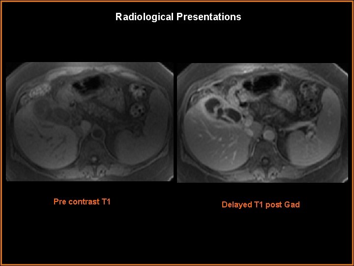 Radiological Presentations Pre contrast T 1 Delayed T 1 post Gad Radiological Presentations Pre contrast T 1 Delayed T 1 post Gad