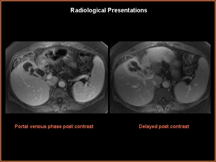 Radiological Presentations Portal venous phase post contrast Delayed post contrast Radiological Presentations Portal venous phase post contrast Delayed post contrast