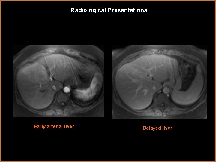 Radiological Presentations Early arterial liver Delayed liver Radiological Presentations Early arterial liver Delayed liver