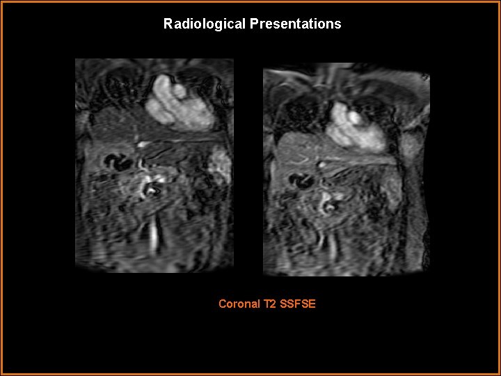 Radiological Presentations Coronal T 2 SSFSE Radiological Presentations Coronal T 2 SSFSE