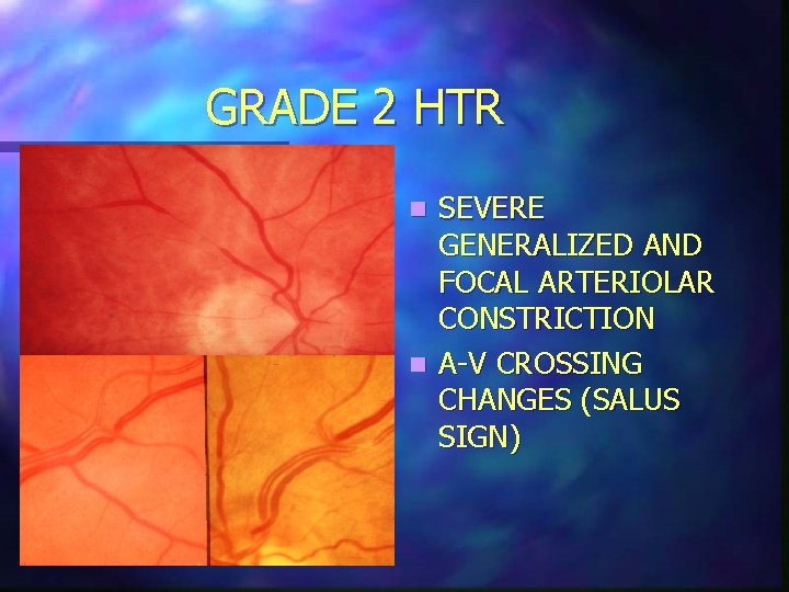 GRADE 2 HTR SEVERE GENERALIZED AND FOCAL ARTERIOLAR CONSTRICTION n A-V CROSSING CHANGES (SALUS