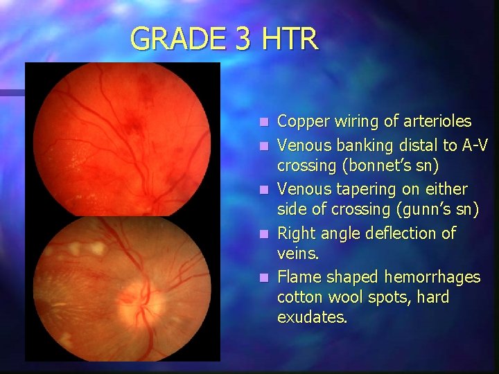 GRADE 3 HTR n n n Copper wiring of arterioles Venous banking distal to