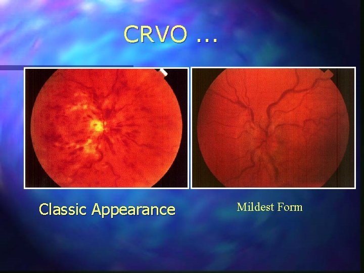 CRVO. . . Classic Appearance Mildest Form 