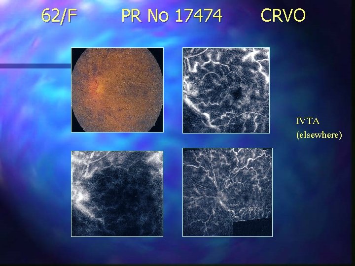 62/F PR No 17474 CRVO IVTA (elsewhere) 