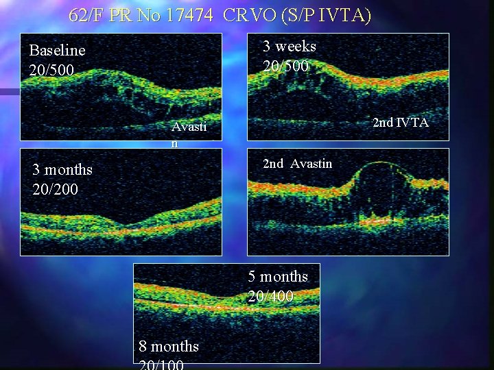 62/F PR No 17474 CRVO (S/P IVTA) 3 weeks 20/500 Baseline 20/500 2 nd