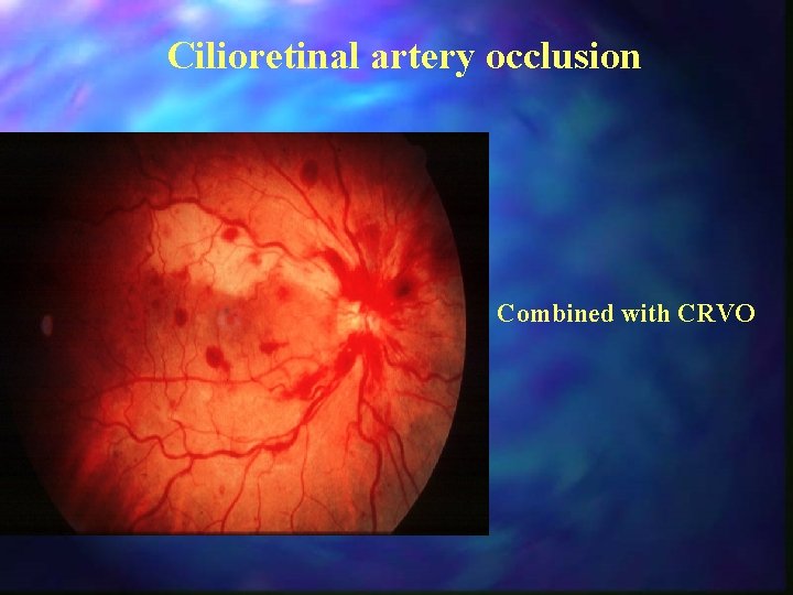 Cilioretinal artery occlusion Combined with CRVO 