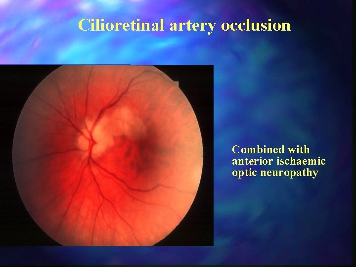 Cilioretinal artery occlusion Combined with anterior ischaemic optic neuropathy 