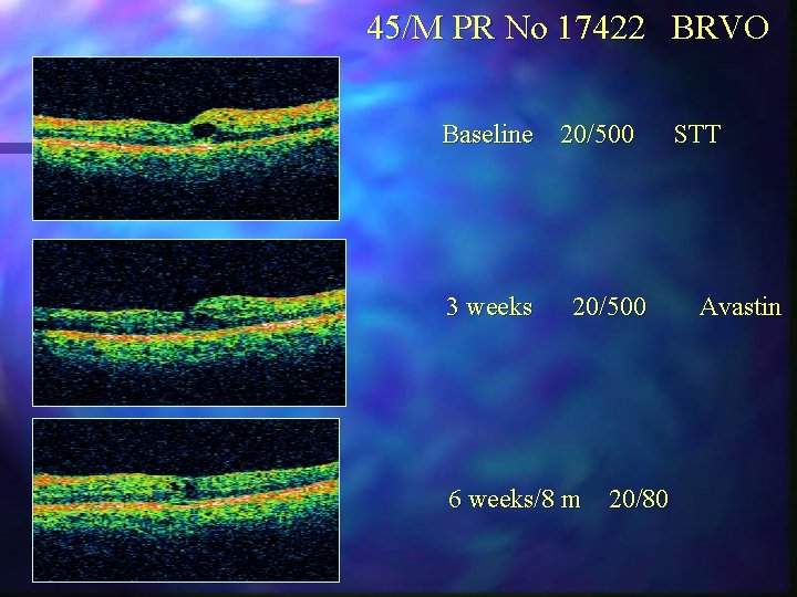 45/M PR No 17422 BRVO Baseline 20/500 3 weeks 20/500 6 weeks/8 m 20/80