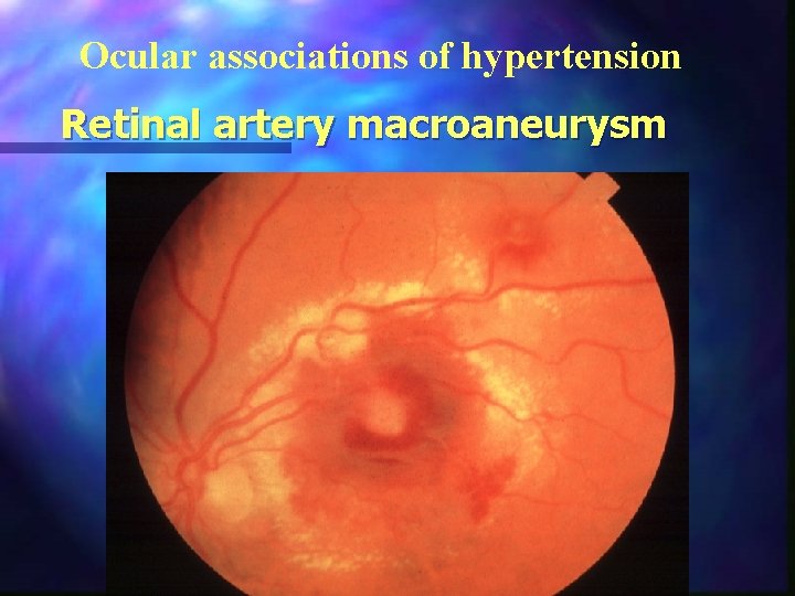 Ocular associations of hypertension Retinal artery macroaneurysm 